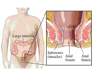 Analna fisura i analna fistula