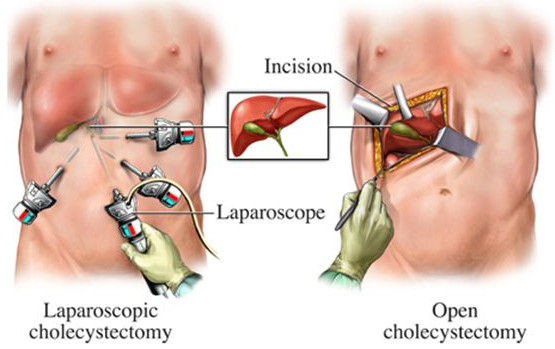 Laparoskopska vs otvorena holecistektomija